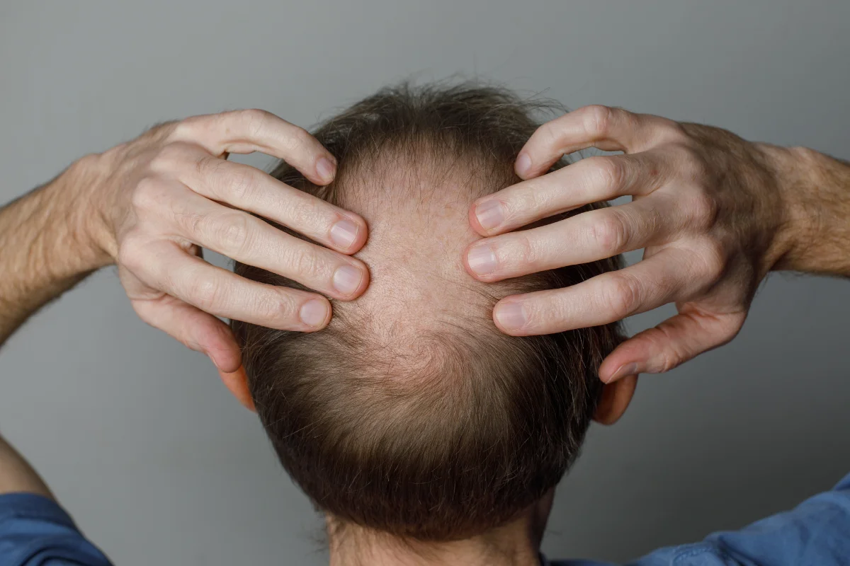 Calvície: receitas caseiras não revertem perda de cabelo e podem causar sérios riscos