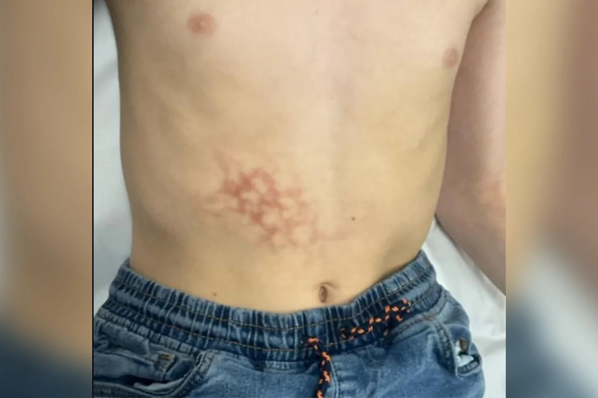 Atenção, pais: Menino desenvolve dermatose rara na barriga por usar notebook no colo