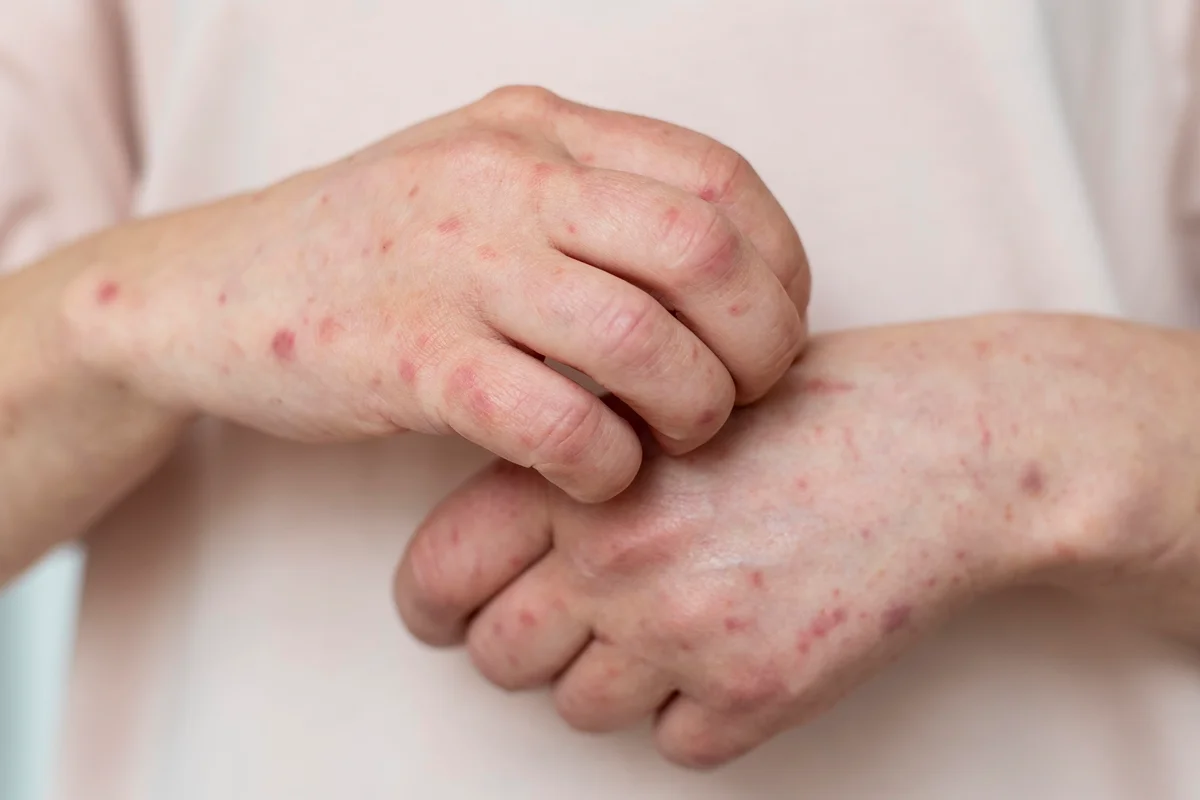 Tatus-de-Nove-Bandas Suspeitos de Causar Surto de Hanseníase na Flórida