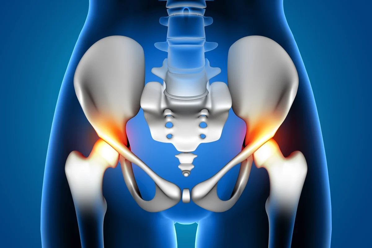 Primeira cirurgia de quadril com enxerto ósseo no DF é um marco na ortopedia