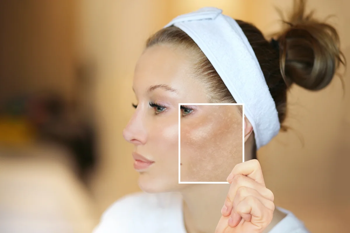 Melasma reaparece porque a pele mantém uma ‘memória’, explica médica