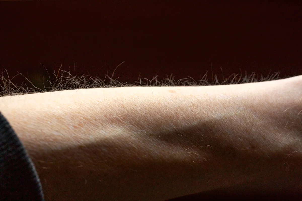 Pelos da pele ajudam a detetar coceira, sugere estudo