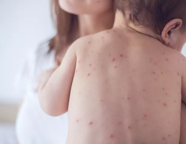 EUA Registram Mais de 2.300 Casos de Sarampo em Acrímena Sequência