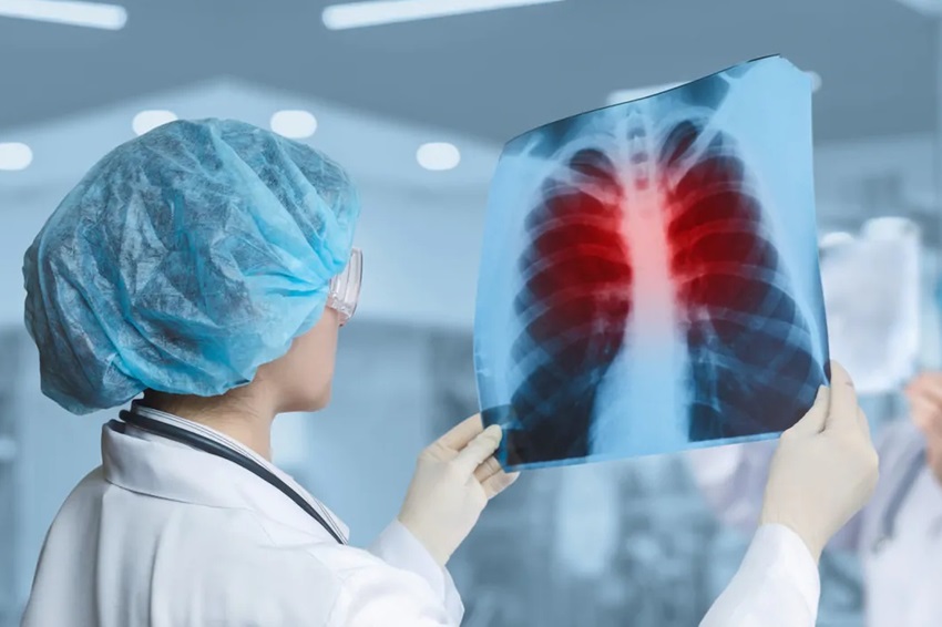 Câmara aprova diretrizes para atenção à saúde de pessoas com hipertensão pulmonar