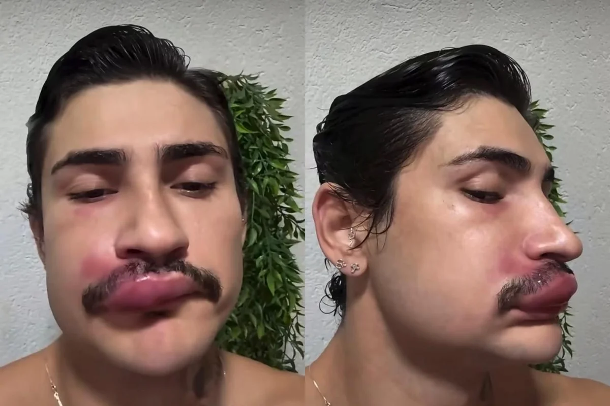 Espremer espinha pode causar infecção grave no rosto