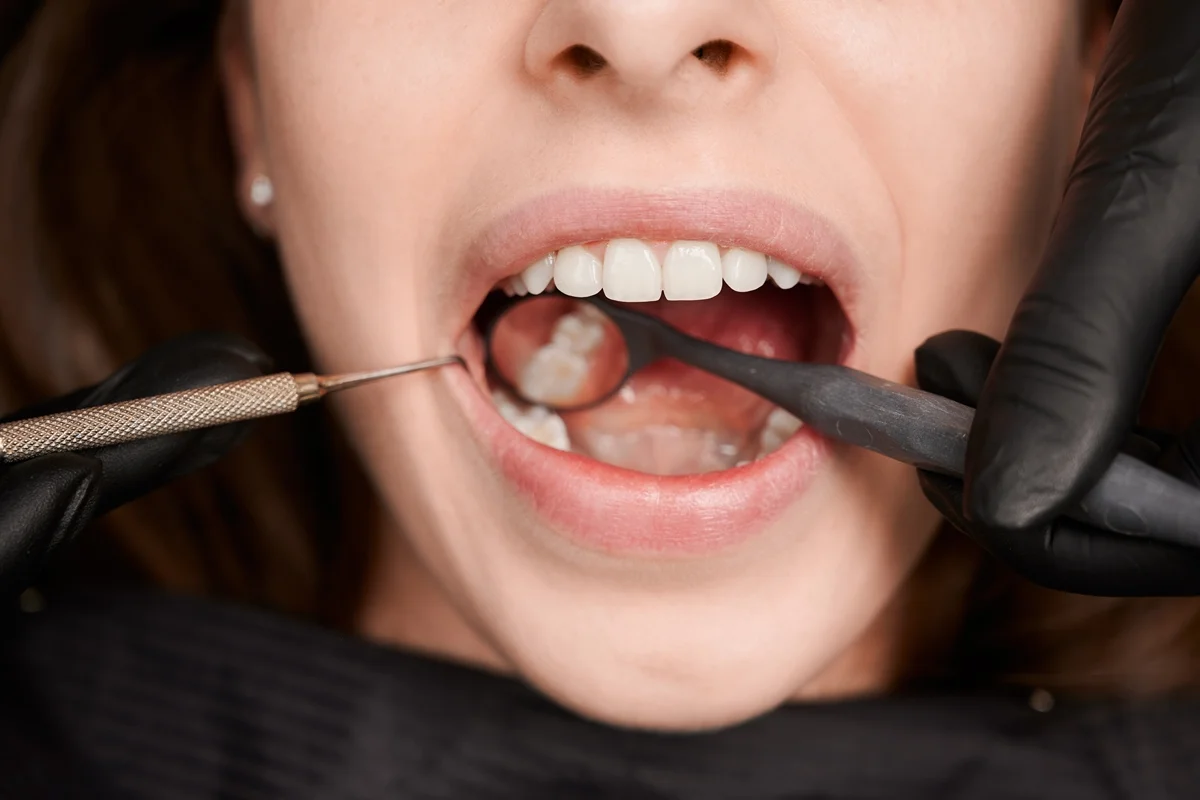 Cientistas desenvolvem novo gel para regenerar dentes danificados pela cárie